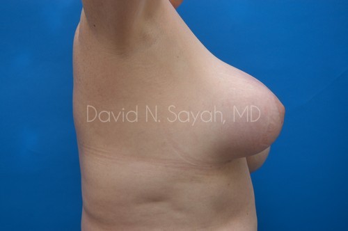 Breast Implant Revision Before and After | Sayah Institute