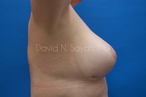 Breast Implant Revision Before and After | Sayah Institute