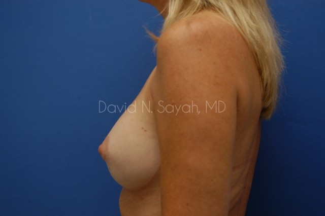Breast Implant Revision Before and After | Sayah Institute