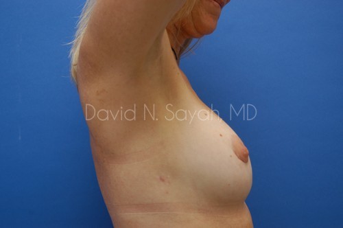 Breast Implant Revision Before and After | Sayah Institute