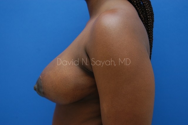 Breast Lift Before and After | Sayah Institute