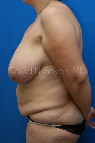 Breast Lift Before and After | Sayah Institute