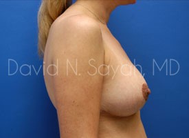 Breast Lift Before and After | Sayah Institute
