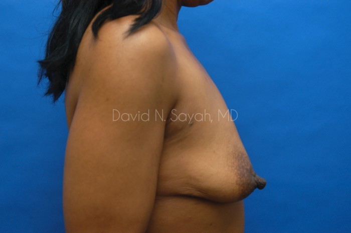 Breast Reconstruction Before and After | Sayah Institute