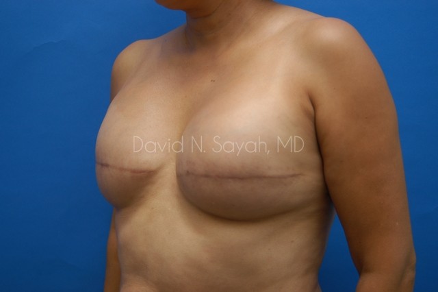 Breast Reconstruction Before and After | Sayah Institute