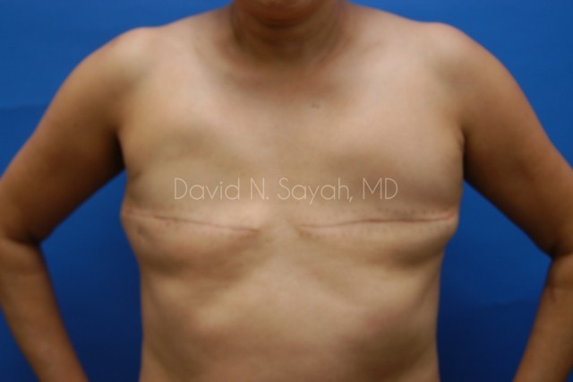Breast Reconstruction Before and After | Sayah Institute
