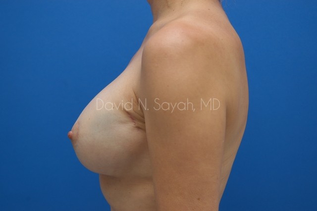 Breast Reconstruction Before and After | Sayah Institute