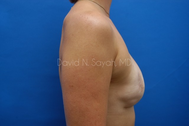 Breast Reconstruction Before and After | Sayah Institute