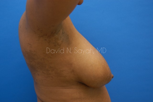 Breast Reconstruction Before and After | Sayah Institute