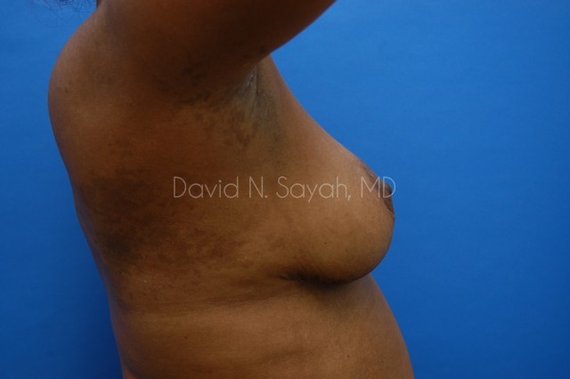 Breast Reconstruction Before and After | Sayah Institute