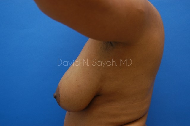 Breast Reconstruction Before and After | Sayah Institute