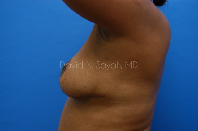 Breast Reconstruction Before and After | Sayah Institute