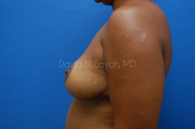 Breast Reconstruction Before and After | Sayah Institute