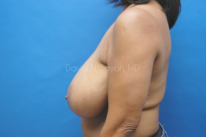 Breast Reduction Before and After | Sayah Institute