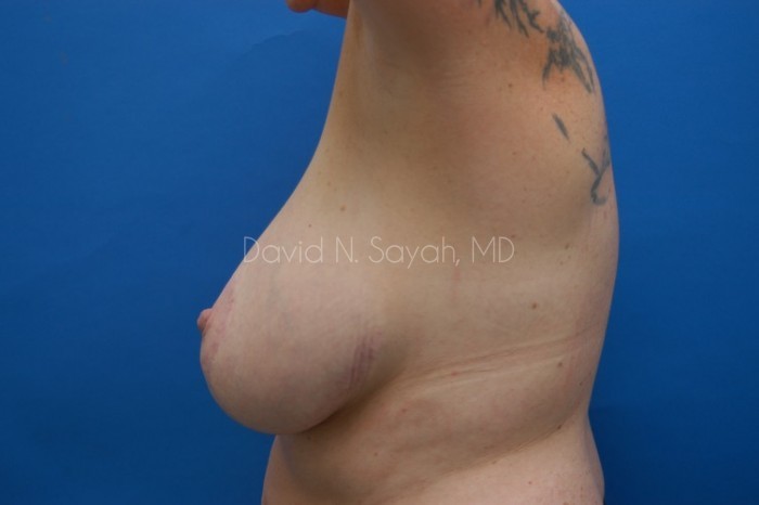 Breast Reduction Before and After | Sayah Institute
