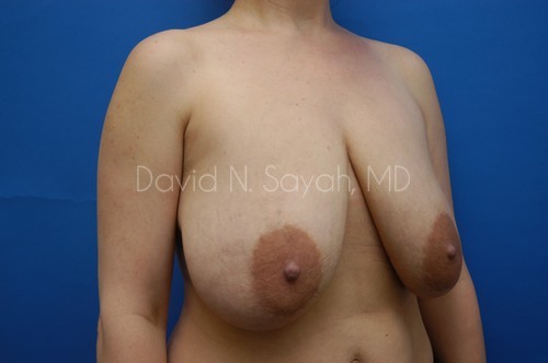 Breast Reduction Before and After | Sayah Institute