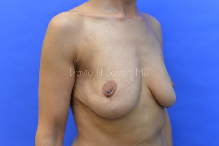 Breast Reduction Before and After | Sayah Institute