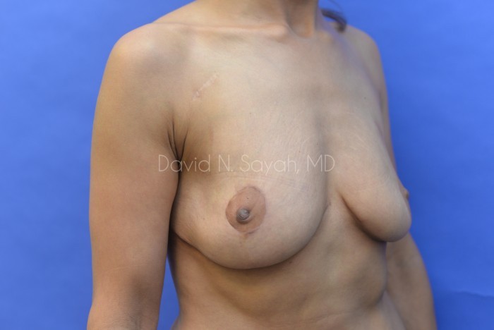 Breast Reduction Before and After | Sayah Institute