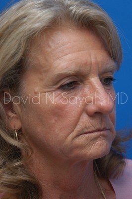 Brow Lift Before and After | Sayah Institute