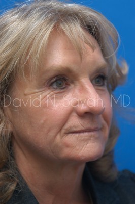 Brow Lift Before and After | Sayah Institute