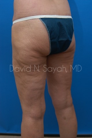 Buttock Lift Before and After | Sayah Institute