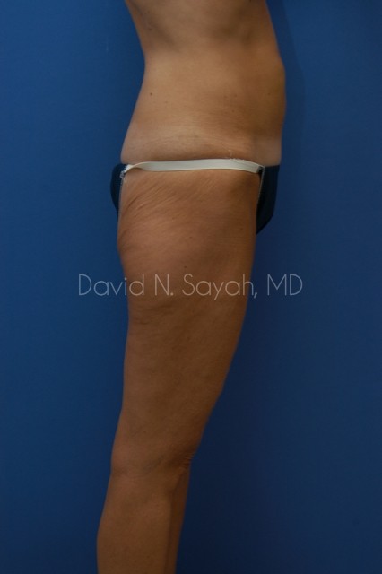Buttock Lift Before and After | Sayah Institute