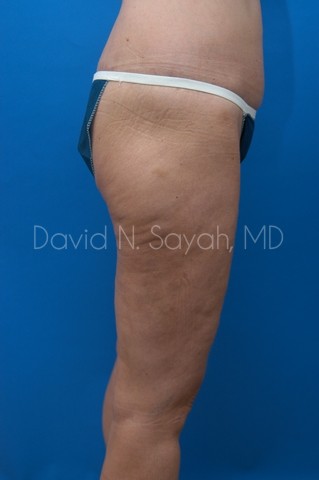 Buttock Lift Before and After | Sayah Institute