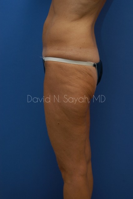 Buttock Lift Before and After | Sayah Institute