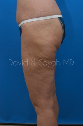 Buttock Lift Before and After | Sayah Institute