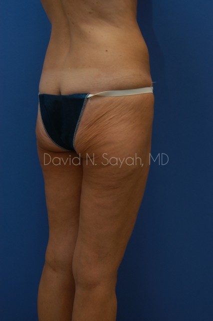 Buttock Lift Before and After | Sayah Institute