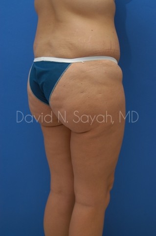 Buttock Lift Before and After | Sayah Institute