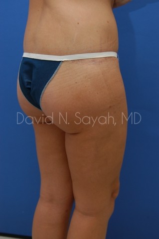 Buttock Lift Before and After | Sayah Institute