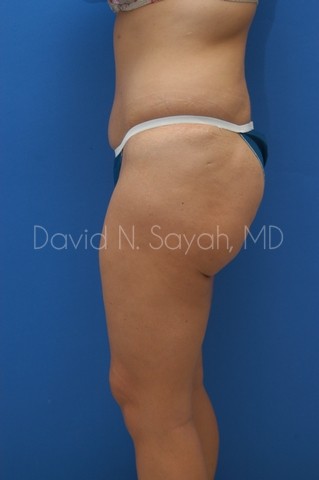 Buttock Lift Before and After | Sayah Institute