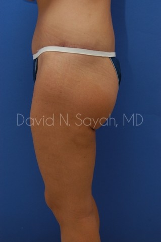 Buttock Lift Before and After | Sayah Institute