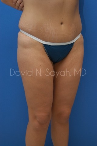 Buttock Lift Before and After | Sayah Institute