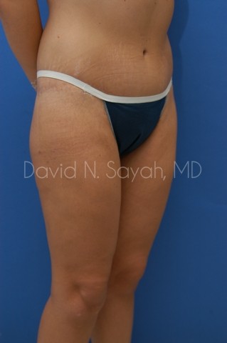 Buttock Lift Before and After | Sayah Institute