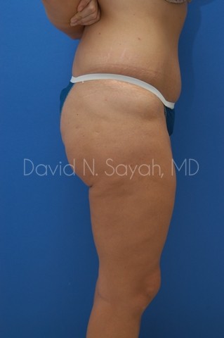 Buttock Lift Before and After | Sayah Institute