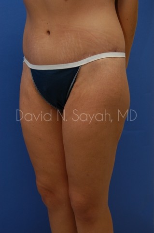 Buttock Lift Before and After | Sayah Institute