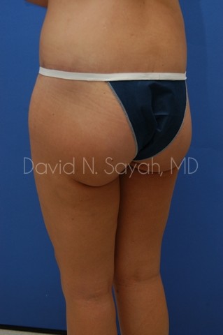 Buttock Lift Before and After | Sayah Institute