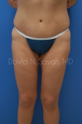 Buttock Lift Before and After | Sayah Institute