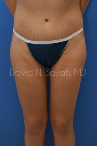 Buttock Lift Before and After | Sayah Institute