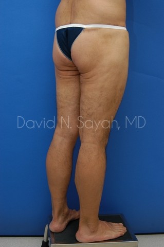 Buttock Lift Before and After | Sayah Institute