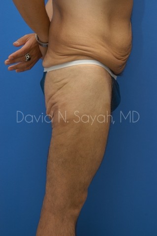 Buttock Lift Before and After | Sayah Institute