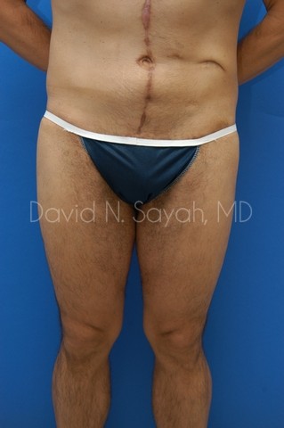 Buttock Lift Before and After | Sayah Institute