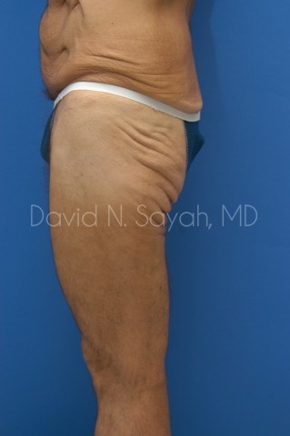 Buttock Lift Before and After | Sayah Institute