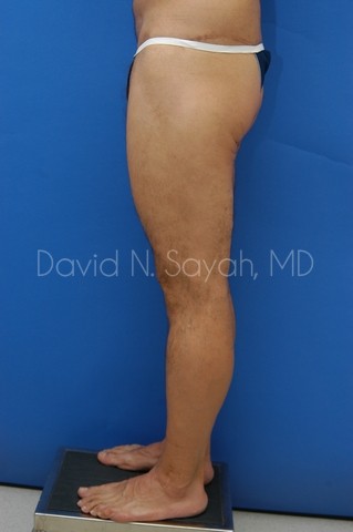 Buttock Lift Before and After | Sayah Institute