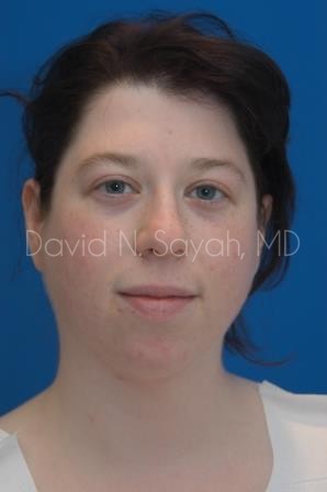 Chin Implant Before and After | Sayah Institute