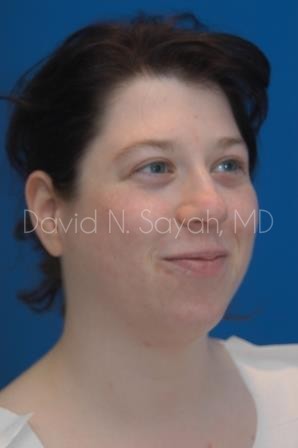 Chin Implant Before and After | Sayah Institute