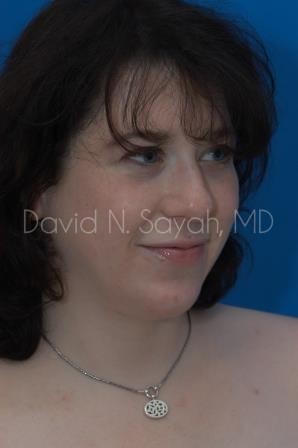 Chin Implant Before and After | Sayah Institute