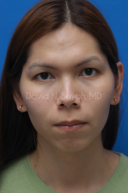 Chin Implant Before and After | Sayah Institute